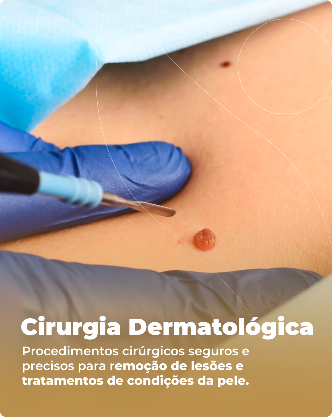 Cirurgia dermatológica